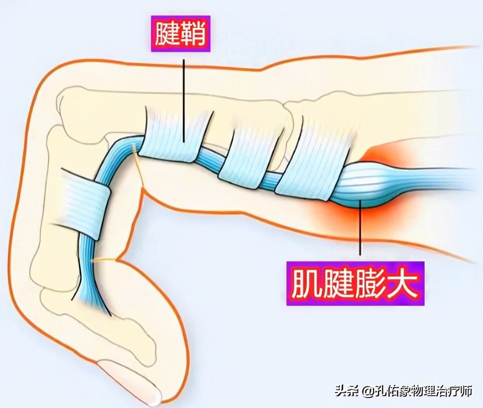 中年人患腱鞘炎怎么治,中老年腱鞘炎特效药