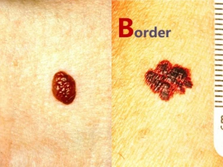 黑色素痣癌变的前兆切除能治愈吗,激光点黑色素痣能诱发恶变吗