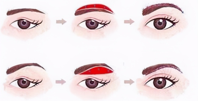 上眼皮松弛怎么锻炼,上眼皮下垂松弛严重