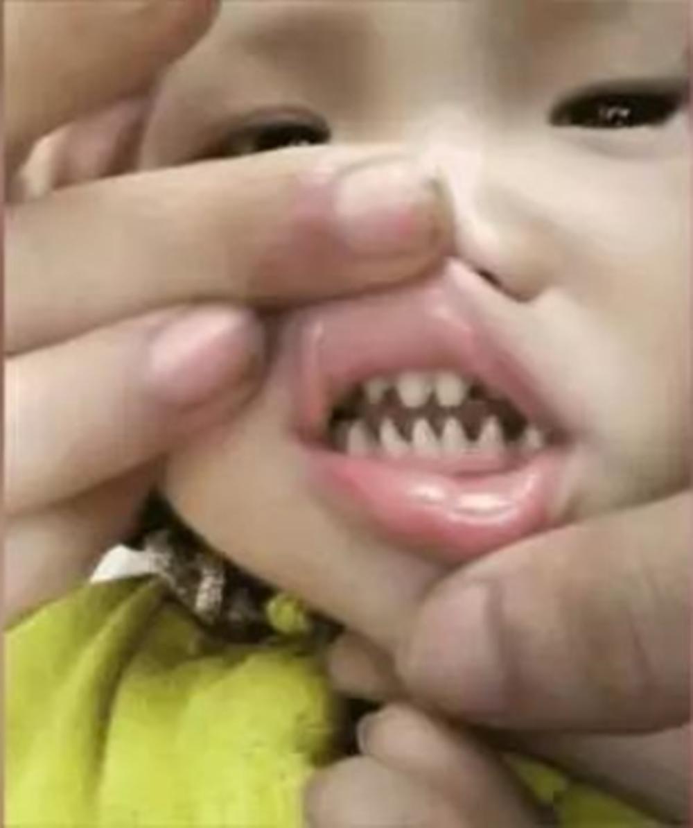 宝宝牙齿怎么长成鲨鱼牙,儿童口腔问题鲨鱼牙