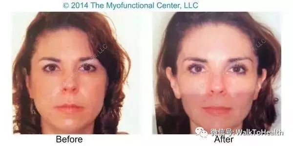 别让口呼吸毁掉你的颜值,脸毁了怎么补救