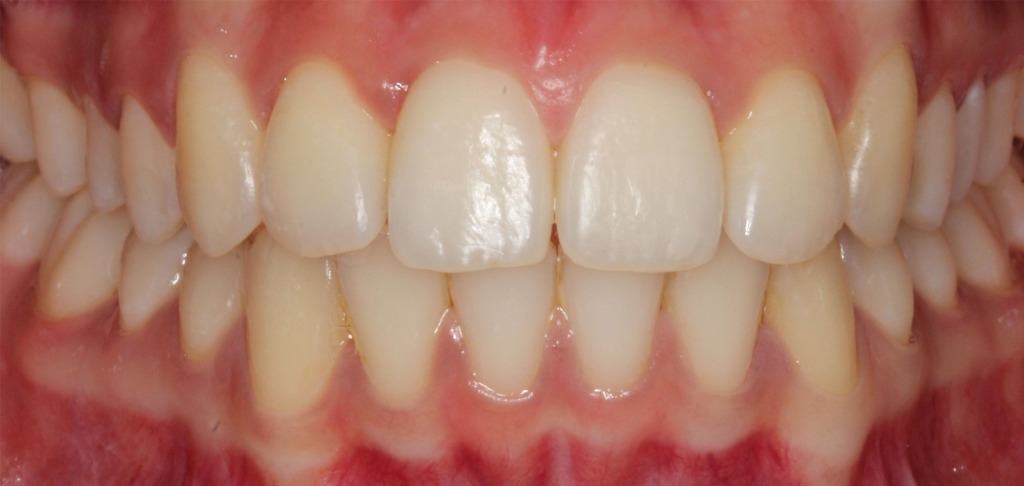 上门牙掉了一块怎么修复,牙磕碰掉了一小块怎么修复