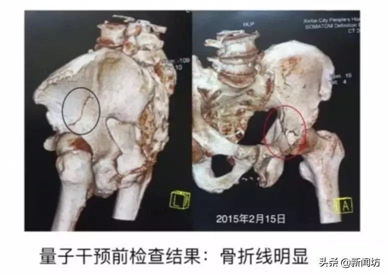 量子速读out了？！有人能拍照治骨折，量子接骨术了解下…