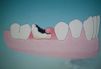 来聊一聊拔牙的那些事,聊一聊看病难的那些事