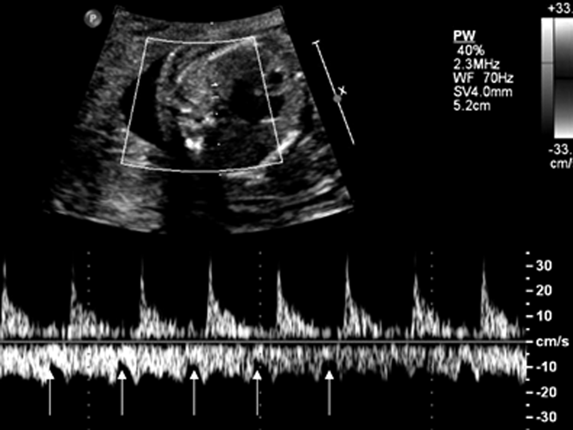 胎儿心电图心跳快是什么原因,胎儿心律不齐超声报告