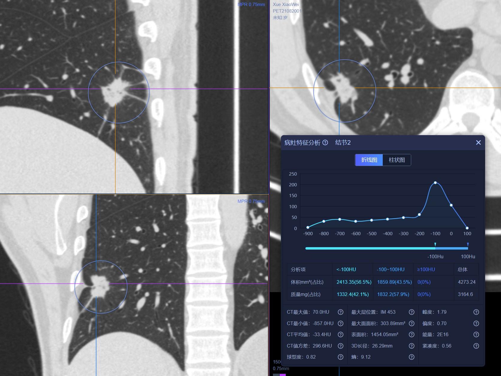 肺结节检查是薄层ct还是三维重建,肺结节检查用什么ct