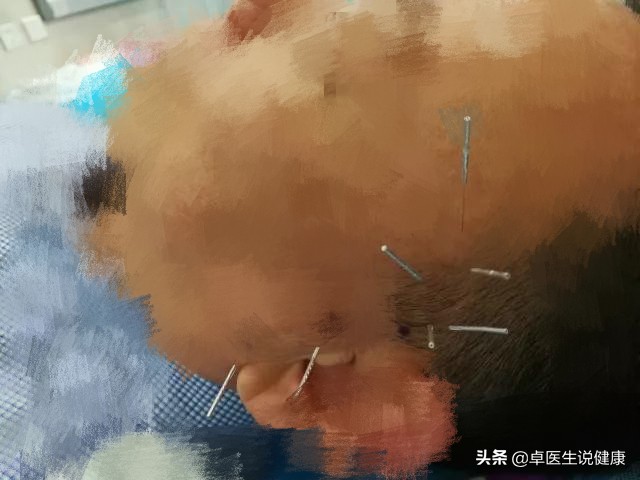 中医眼科飞蚊症验方大全,中医治疗飞蚊症穴位