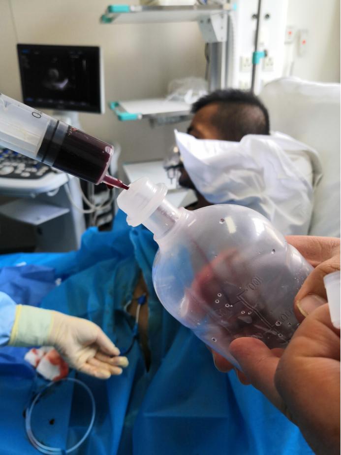 肾积液心包积液,肾移植有积液怎么回事