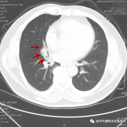 警惕反复发烧,警惕反复感染