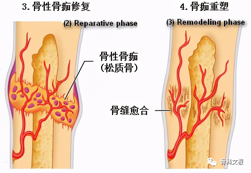 骨折了怎么一直不消肿吃什么药,骨折延缓愈合和骨不连的区别在哪