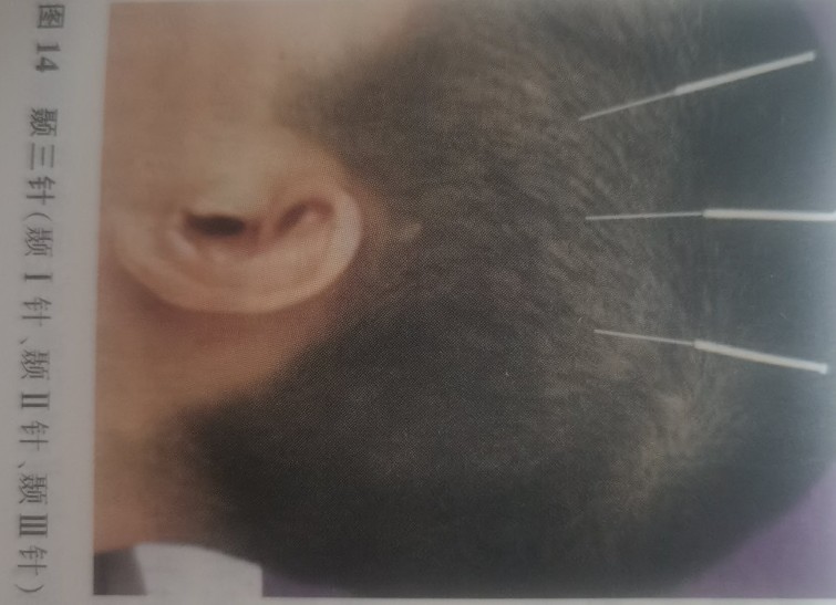 解决头晕恶心的小妙招,头晕的疑难杂症怎么治疗