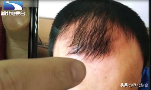 最简单有效的生发秘方,苗家秘方生发