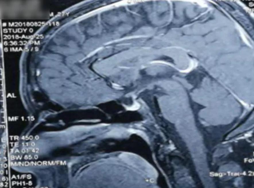 感觉身体淋巴结游走性疼痛,全身多处炎性淋巴结