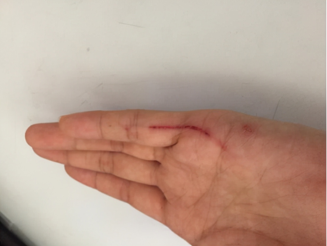 被狗咬伤打疫苗10年后就没事了吗,被狗咬伤打了疫苗还会有潜伏期吗