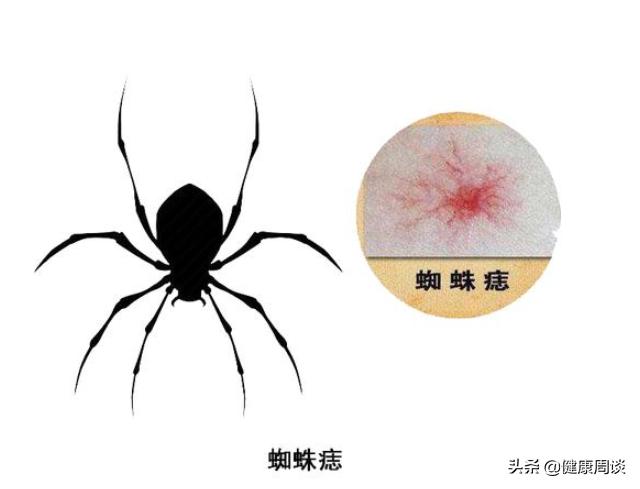 红色的蜘蛛痣咋回事,肝病蜘蛛痣出现是早期还是晚期
