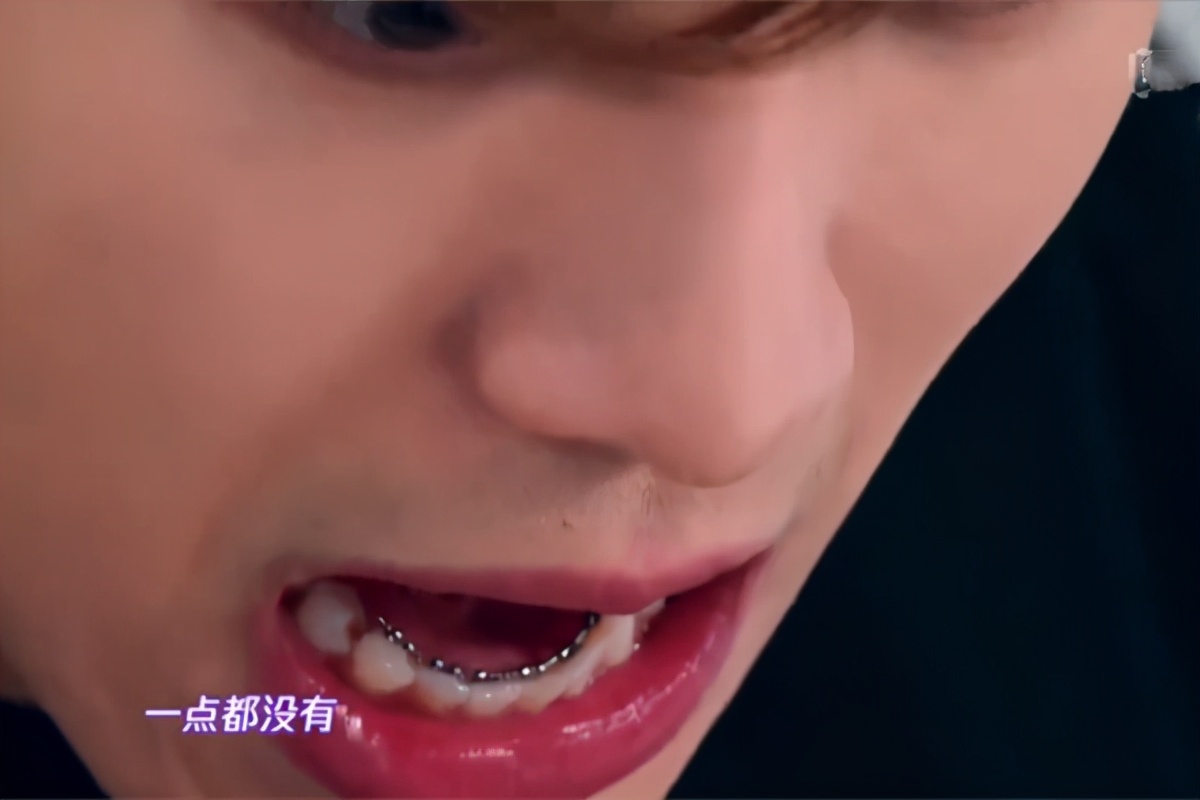 矫正牙齿选择什么托槽好,罗云熙牙齿矫正对比