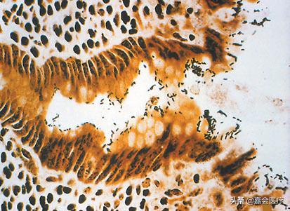 为什么吃冰激凌会引起细菌感染,吃了感染细菌的冰淇淋怎么办