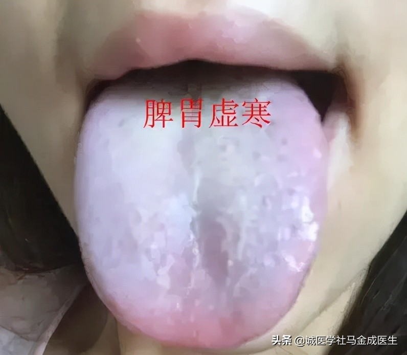 脾虚齿痕舌整天乏困吃什么中成药,治疗脾虚齿痕舌最好的中成药
