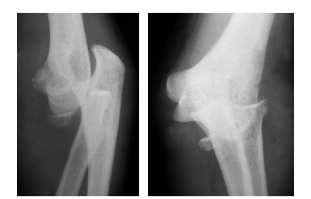 青少年肘部损伤最常见的是,肘部桡神经损伤的临床表现