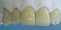 氧化锆全瓷牙的缺点和优点,牙医建议烤瓷不建议全瓷