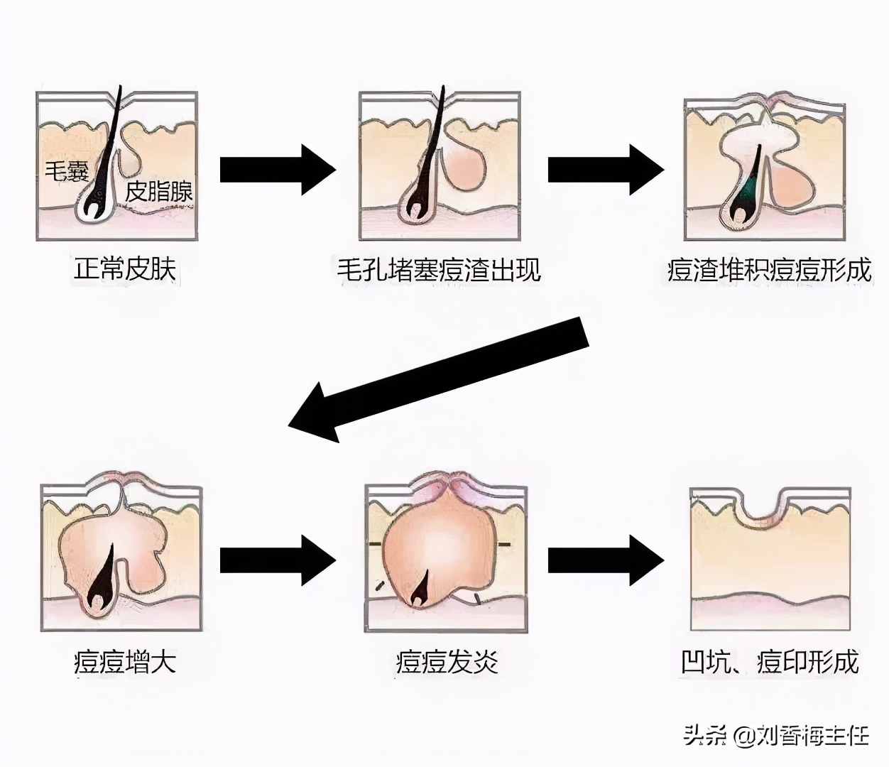 痘印痘坑对颜值的影响,严重的痘坑护肤可以修复吗