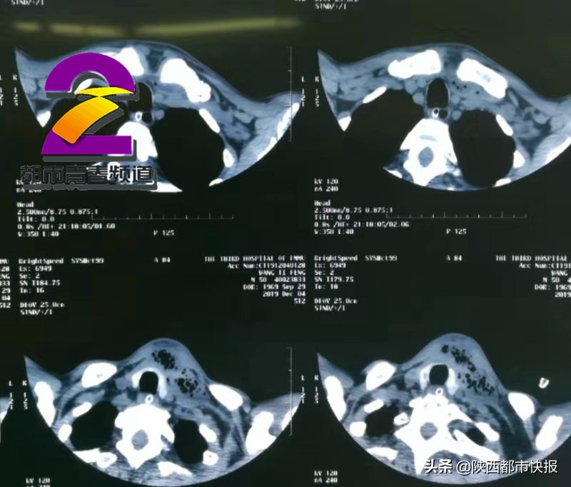 男子牙疼出脓液,男子因牙疼致感染
