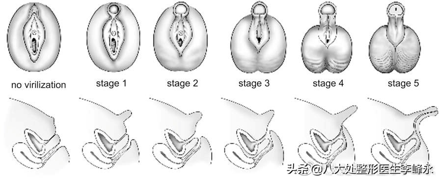 假性两性畸形是怎样形成的,两性畸形的早期症状