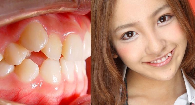 儿童老虎牙矫正,儿童虎斑牙怎么解决