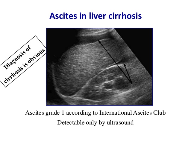 肝纤维化怎样有效逆转,早期肝纤维化和轻度肝纤维化