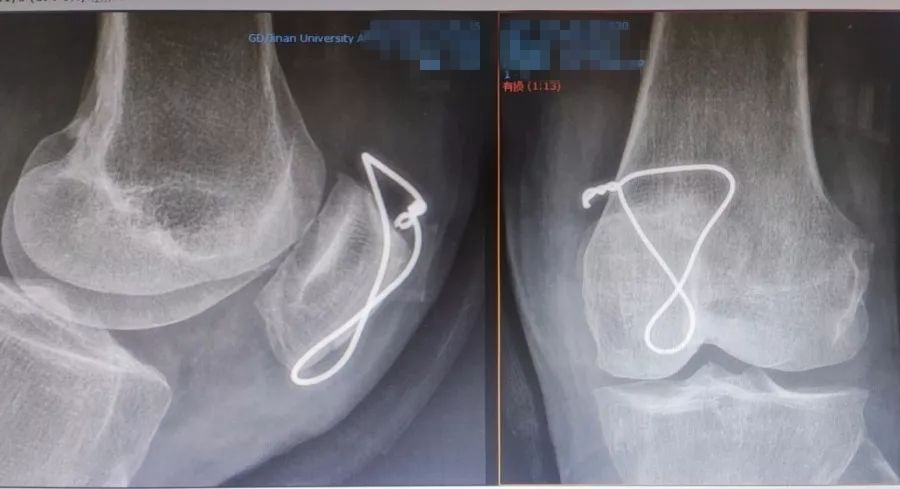 阿婆路边摔伤,阿婆骨折手术
