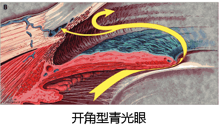 青光眼预防,认识青光眼