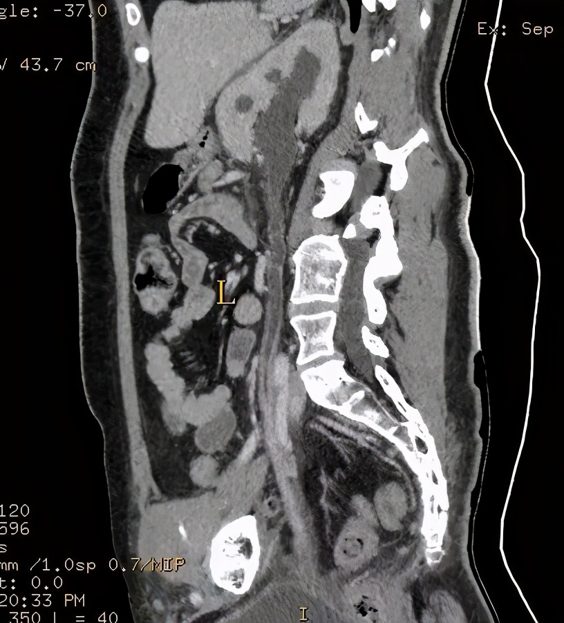 尿路造影输尿管间断显影,静脉尿路造影和排泄性尿路造影
