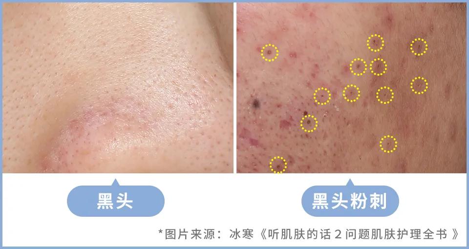 如何用简单的方法去黑头真实有效,别挤了教你去黑头的正确方法