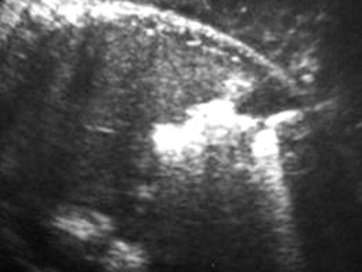 胎儿消化道畸形的诊断,胎儿消化道畸形超声