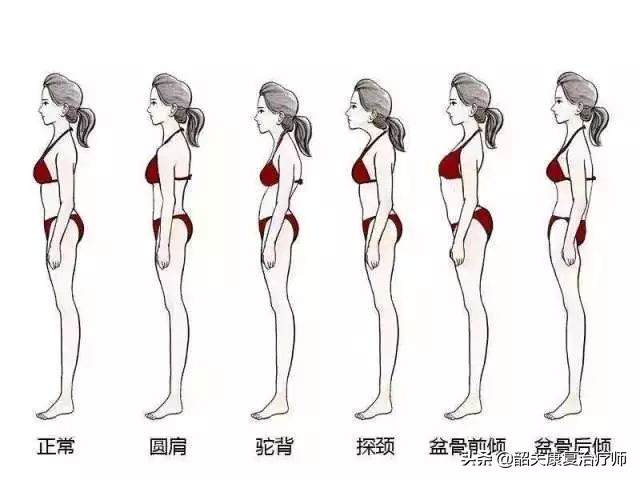 什么是下交叉综合征？下交叉综合症的解剖分析与纠正训练