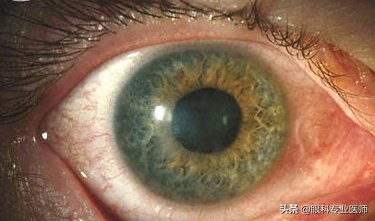 流行性角结膜炎吃什么中成药,流行性角结膜炎