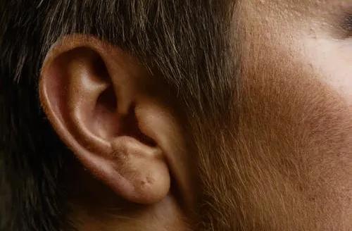 突发性耳聋耳鸣最好的治疗方案,耳鸣不用吃药最好治疗方法