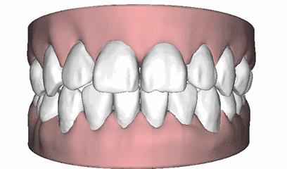 很小的牙缝会恢复吗,牙缝大了能有补救吗
