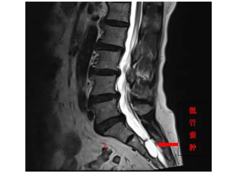 尾椎骨下方屁股两处反复长水泡,尾椎骨附近起了水泡是怎么回事