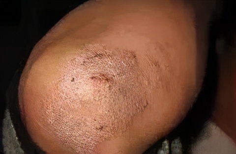 神经性皮炎反复发作，怎样才能摆脱它？