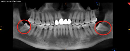 长智齿是不是因为要变聪明,长智齿是不是因为聪明一点