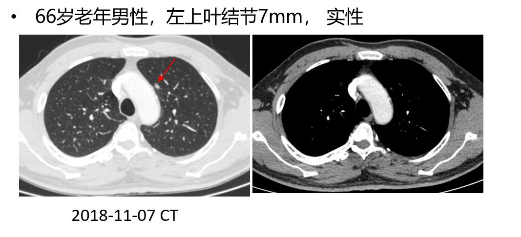 支气管镜高频电刀治疗中央型肺癌,支气管镜在早期肺癌诊断的意义