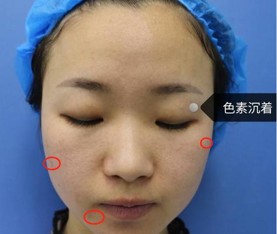 激光美白小妙招,激光美白哪种效果最好