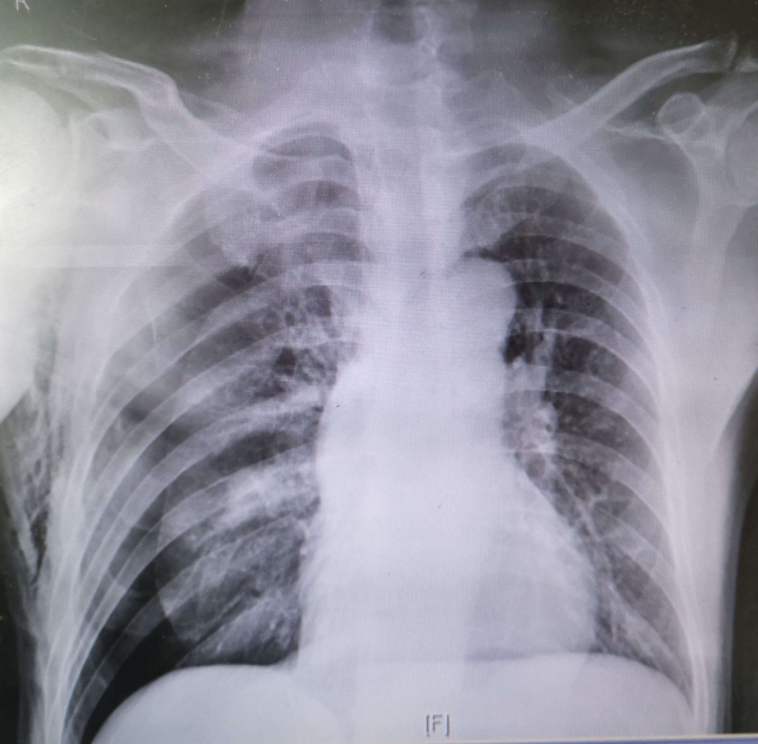 用大气管给气球充气危险吗,气球充太饱会爆破吗