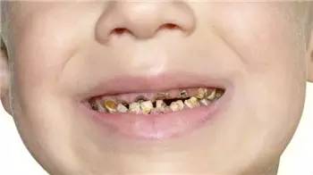小孩喝可乐喝的牙齿都没了,小孩子喝可乐腐蚀牙齿