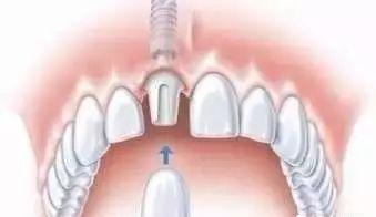 怎么样看牙最省钱,看牙嫌贵这个省钱机会千万别错过