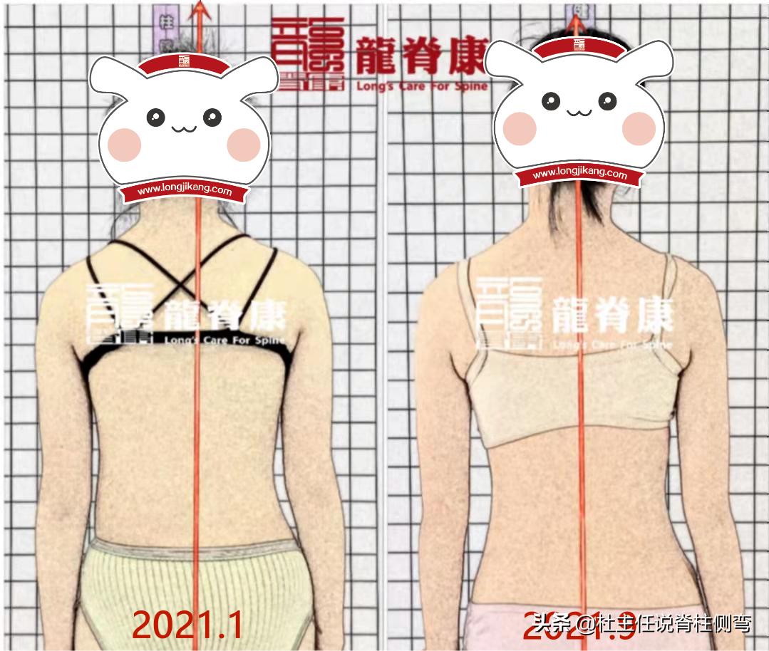 14岁女孩侧弯治疗一年后,12岁女孩脊柱s型侧弯17度怎么治