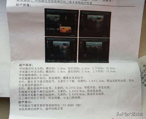 50岁甲状腺结节有钙化正常吗,55岁甲状腺结节