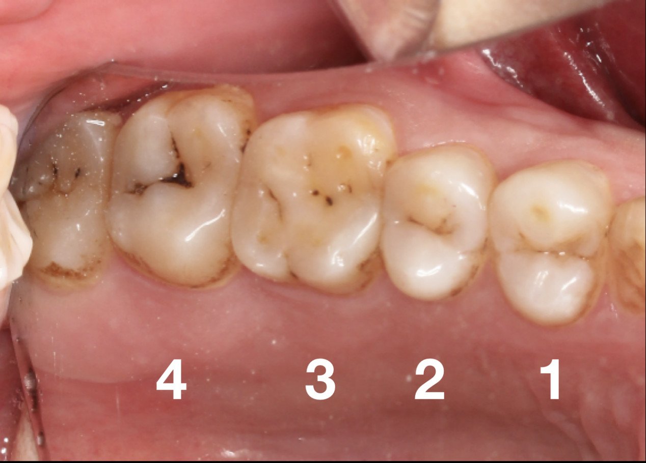小孩牙齿边缘有黑线要怎么补救,牙齿长黑的东西怎么处理