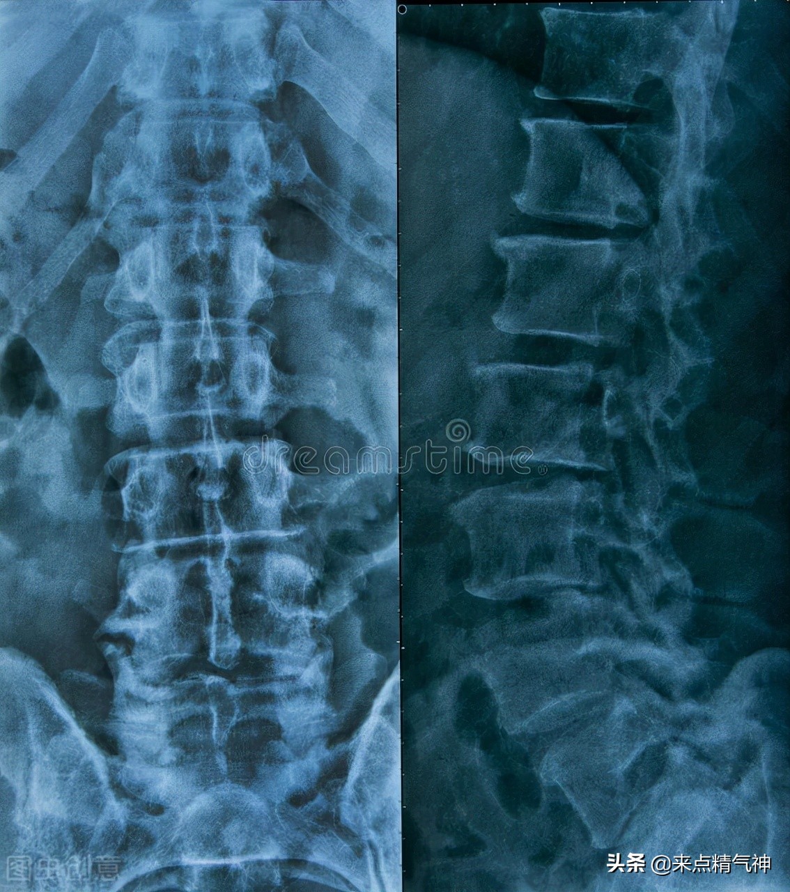 为什么会得腰椎结核,腰椎结核病最佳治疗方案